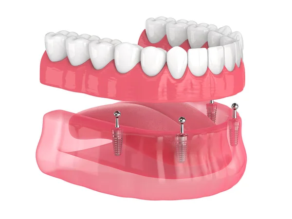 All Removable Implants Supported Overdenture Installation White Background — Stock Photo, Image