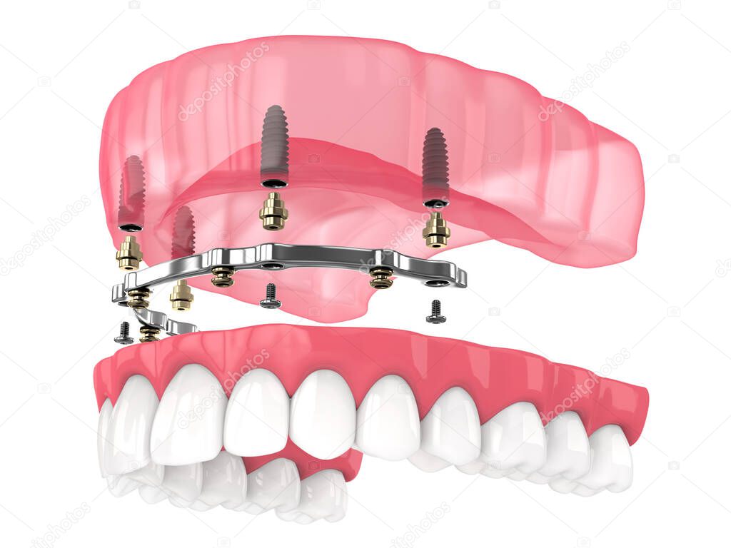 Bar retained removable overdenture installation supported by implants over white backgroud