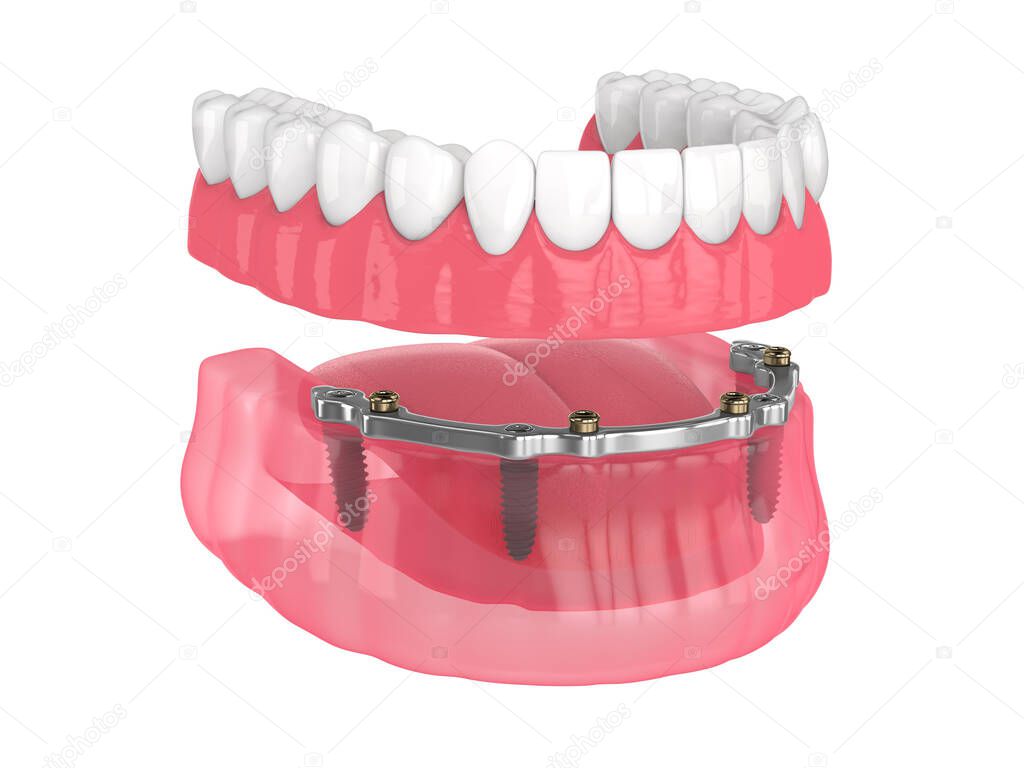 Bar retained removable overdenture installation supported by implants over white backgroud