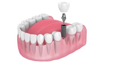 beyaz arkaplan üzerinde düşük çeneye diş implantı yerleştirme