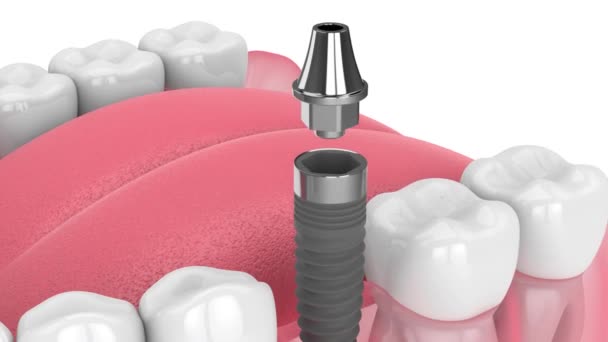 Colocación Implantes Dentales Mandíbula Inferior Sobre Fondo Blanco — Vídeos de Stock