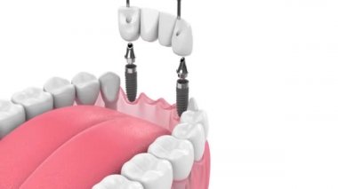 beyaz arkaplan üzerinde implantlar tarafından desteklenen diş köprüsü ile çene
