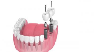 Diş köprüsü insan çenesine yerleştirilen implantlar tarafından destekleniyor