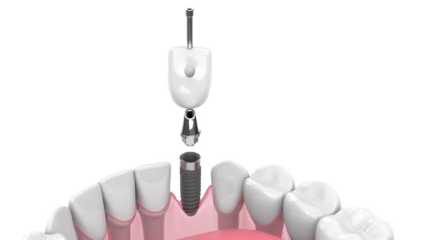 Tandheelkundige Brug Ondersteund Door Implantaten Geïnstalleerd Menselijke Kaak — Stockvideo