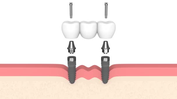 Dental Bridge Supported Implants Installed Human Gums — Stockvideo