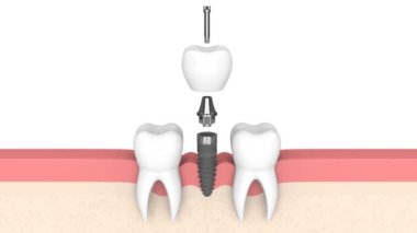 Diş implantı beyaz arka planda insan diş etlerine yerleştirilmiş.