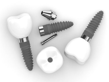 Beyaz masada duran üç boyutlu diş implantı.