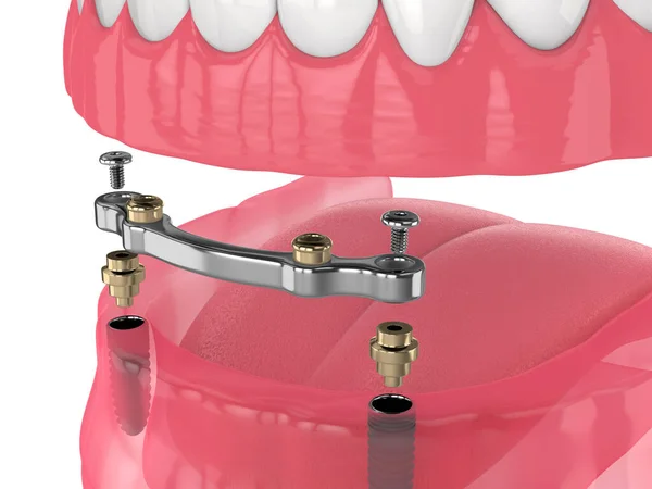 Render Bar Retained Removable Overdenture Installation Supported Two Implants — Stock fotografie