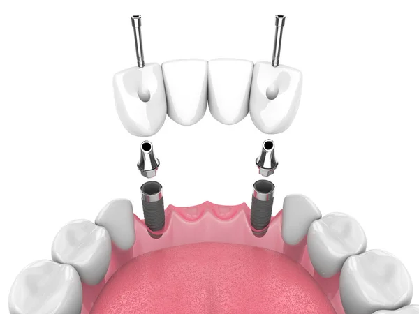 Візуалізація Щелепи Зубним Мостом Підтримуваним Імплантатами Білому Тлі — стокове фото
