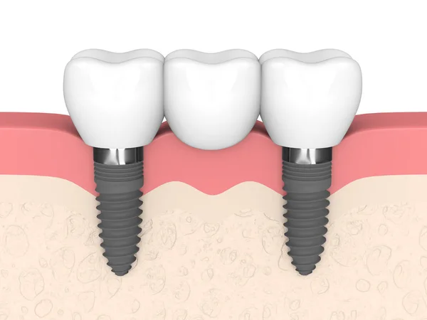 Візуалізація Щелепи Зубним Мостом Підтримуваним Імплантатами Білому Тлі — стокове фото