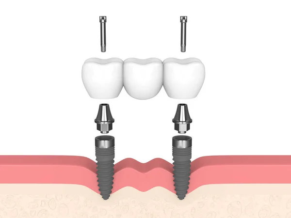 Render Jaw Dental Bridge Supported Implants White Background — 스톡 사진