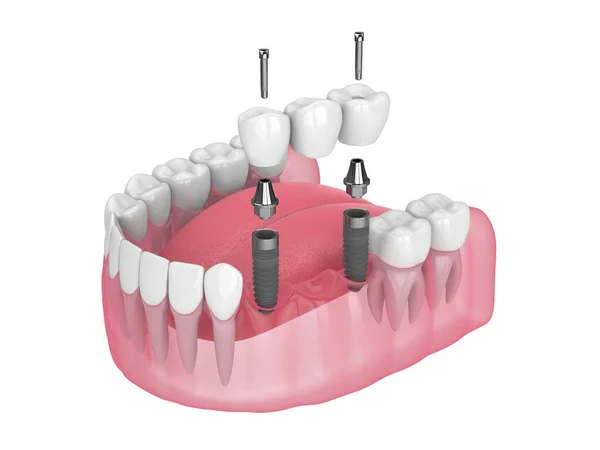 Vykreslení Čelisti Zubním Můstkem Podepřeným Implantáty Čelisti Přes Bílé Pozadí — Stock fotografie