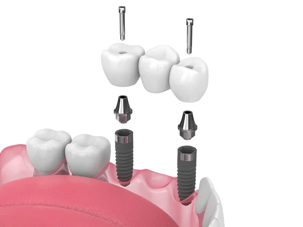Diş Köprüsü Destekli Çene Oluşturma Beyaz Arkaplan Üzerine Implantlar Tarafından — Stok fotoğraf