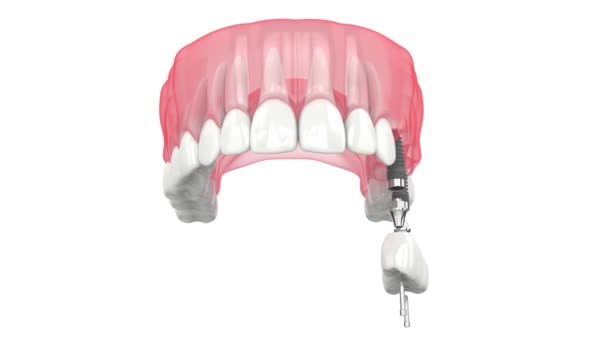 Szczęka Górna Mostem Zębowym Podpartym Implantami — Wideo stockowe