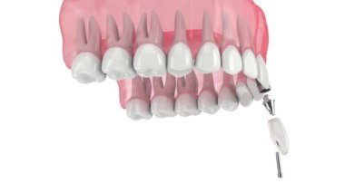 Kesici diş implantı beyaz arkaplan üzerine yerleştirilmiş üst çene 