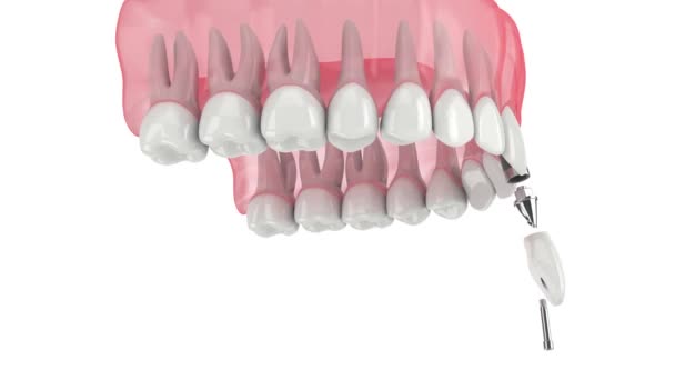 Верхня Щелепа Імплантацією Зубів Білому Фоні — стокове відео
