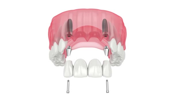 Bovenkaak Met Tandheelkundige Brug Ondersteund Door Implantaten — Stockvideo