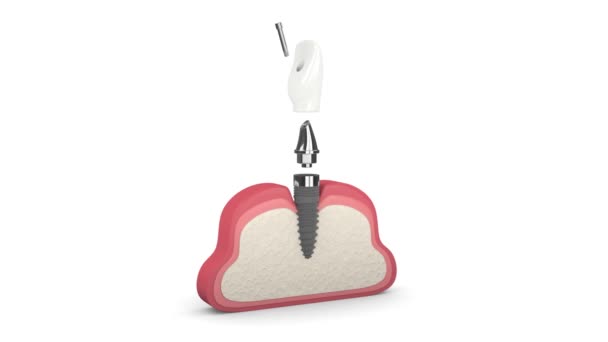 Human Gum Incisor Dental Implant Installation White Background — 비디오