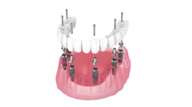 Dental prosthesis all-on-6 system supported by implants