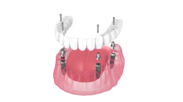 Dental Prosthesis All System Supported Implants — Vídeo de stock