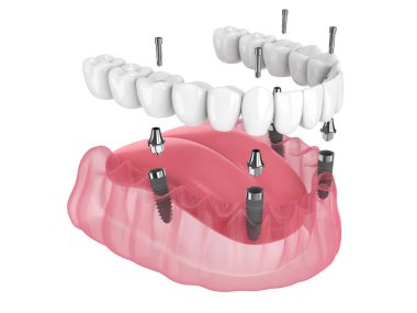 Mandibular prosthesis all on 4 system supported by implants over white background