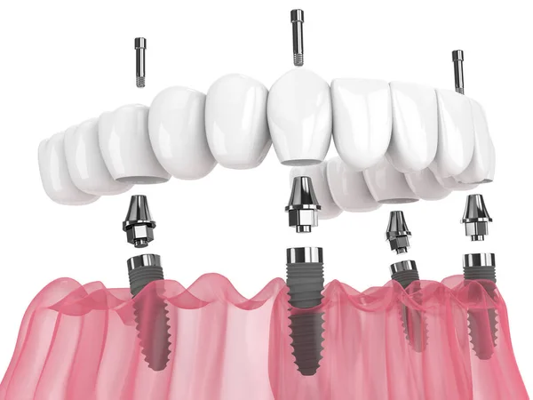 Mandibular Prosthesis All System Supported Implants White Background — Stock Fotó