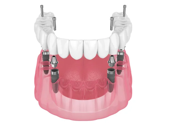 Mandibular Prosthesis All System Supported Implants White Background — стоковое фото