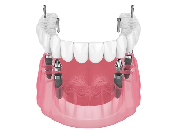 Mandibular Prosthesis All System Supported Implants White Background — Fotografia de Stock