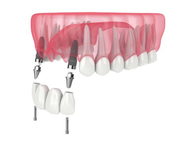 3d render of jaw with dental incisors bridge supported by implants over white background