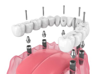 3d render of mandibular prosthesis all-on-6 system supported by implants over white background