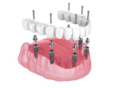 3d render of mandibular prosthesis all-on-6 system supported by implants over white background