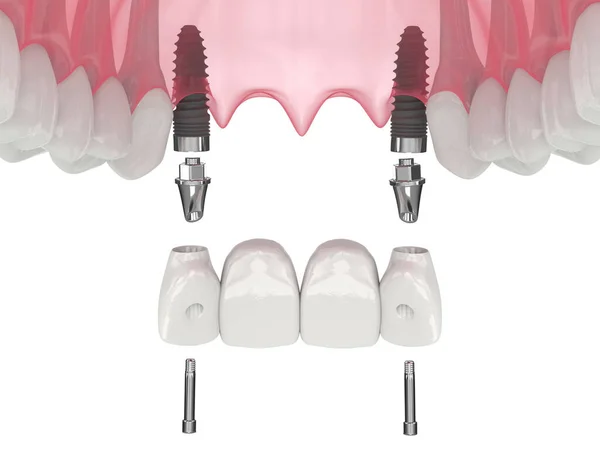 Візуалізація Щелепи Мостом Різання Зубів Підтримуваним Імплантатами Білому Тлі — стокове фото
