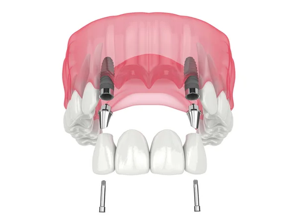 Render Jaw Dental Incisors Bridge Supported Implants White Background — Stockfoto