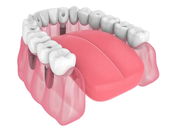 Render Mandibular Prosthesis All System Supported Implants White Background — Fotografia de Stock