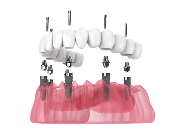 Render Mandibular Prosthesis All System Supported Implants White Background — Stock Photo, Image