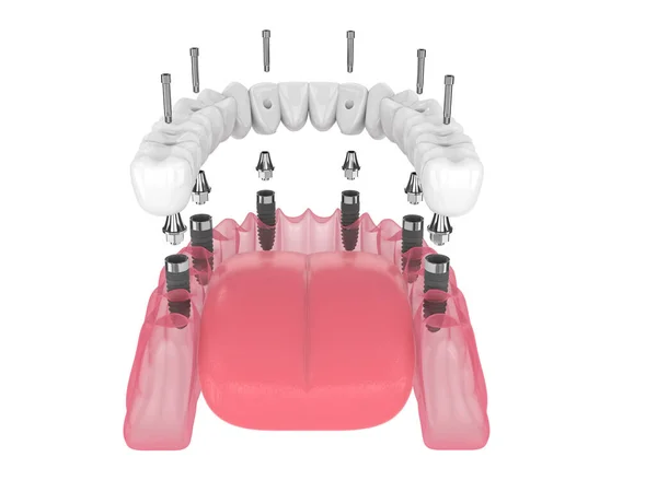 Render Mandibular Prosthesis All System Supported Implants White Background — Zdjęcie stockowe