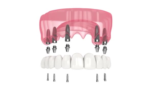 Dental Prosthesis All System Supported Implants — Stok video
