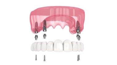 Dental prosthesis all-on-4 system supported by implants