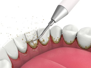 Removing tartar and plaque from teeth by ultrasonic scaler. Dental descaling concept