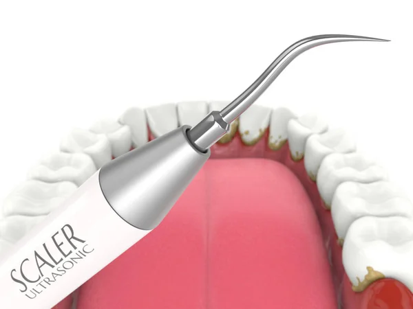 Removing Tartar Plaque Teeth Ultrasonic Scaler Dental Descaling Concept — Stock Photo, Image