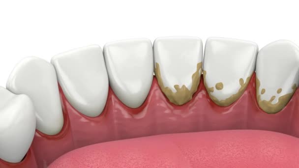 Видалення Зубного Каменю Зубного Нальоту Зубів Допомогою Ультразвукового Скалеру Концепція — стокове відео