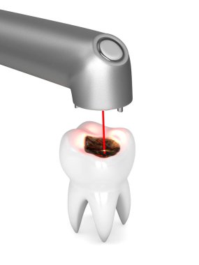 3d render of removing tooth decay with dental laser. Painless tooth cleaning without dental drill concept