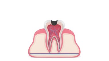 Removing tooth decay with dental laser without dental drill