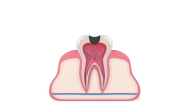 Removing Tooth Decay Dental Laser Dental Drill — 图库视频影像