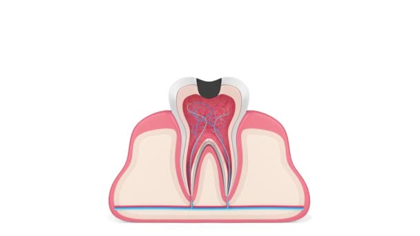 Removing Tooth Decay Dental Laser Dental Drill — Video Stock