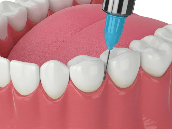 Renderizado Mandíbula Humana Con Procedimiento Anestesia Intraligamentaria Sobre Fondo Blanco —  Fotos de Stock