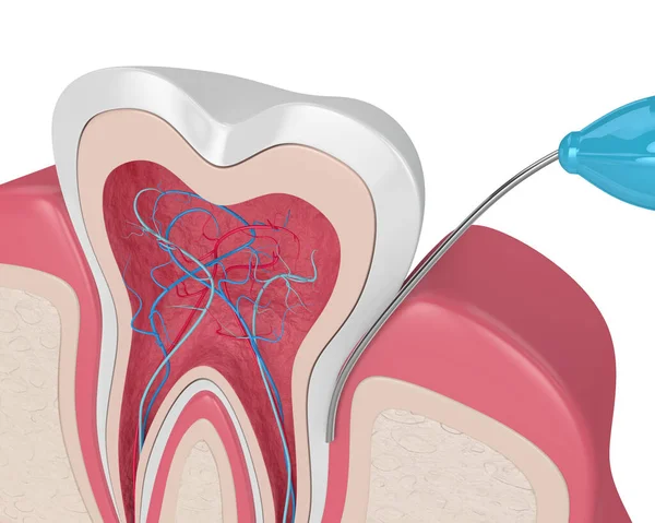 歯の3Dレンダリング白い背景の上に腹膜麻酔手順を持つ歯茎で — ストック写真