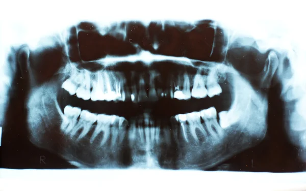 Imagen escaneada de una radiografía de un diente humano —  Fotos de Stock