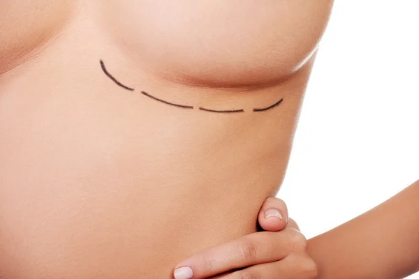 Woman breast marked out for cosmetic surgery — Stock Photo, Image