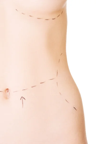 Woman belly marked out for cosmetic surgery. — Stock Photo, Image